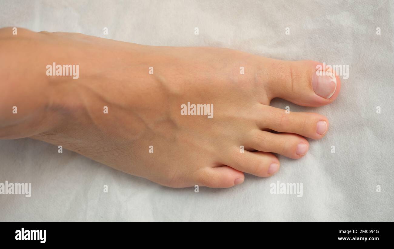 Top view of foot and toes with unhealthy nail. Stock Photo