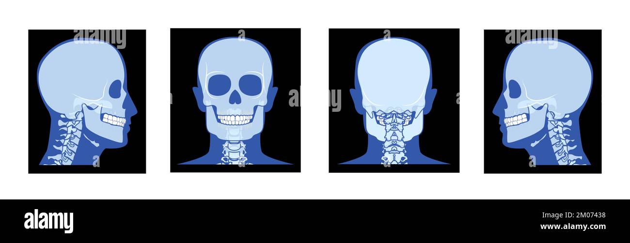 Set of X-Ray Head and neck Skeleton Human body Bone adult people roentgen front back side view. 3D realistic flat blue color concept Vector illustration of medical anatomy isolated on black background Stock Vector