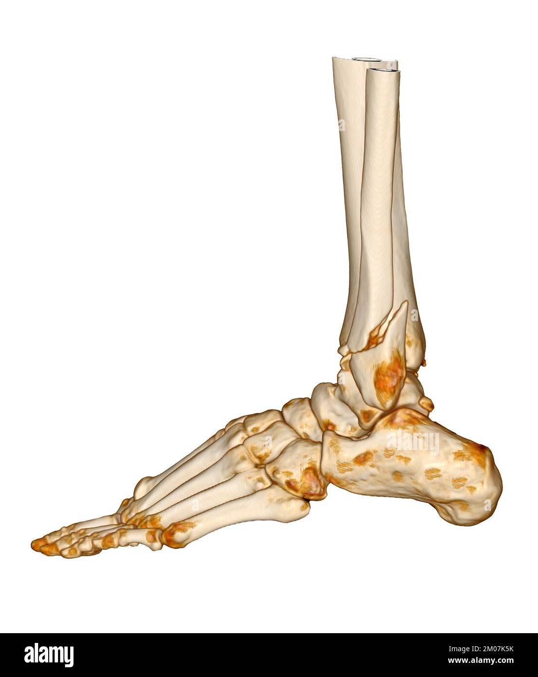 CT Scan ankle and foot or Computed Tomography of Ankle joint and Foot