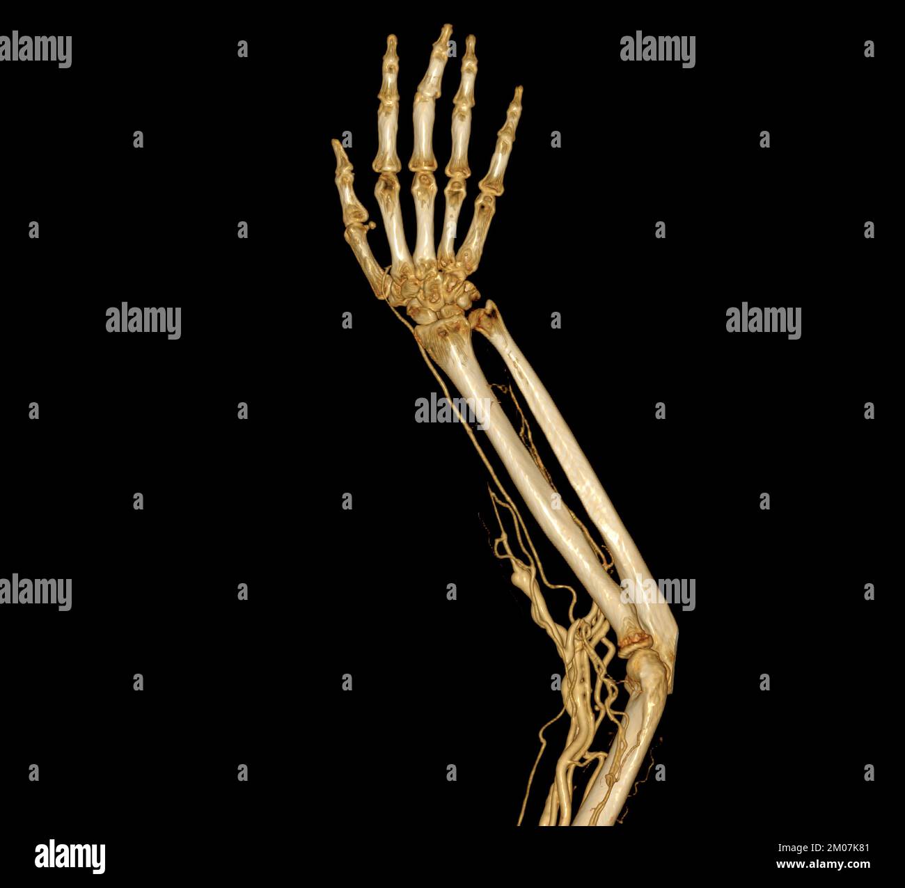 Brachial Arteries of the arm with Upper extremity Bone 3D rendering  from CT Scanner. Stock Photo