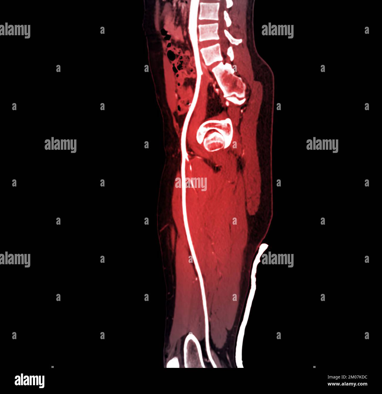 CTA femoral artery run off image of femoral artery for diagnostic Acute