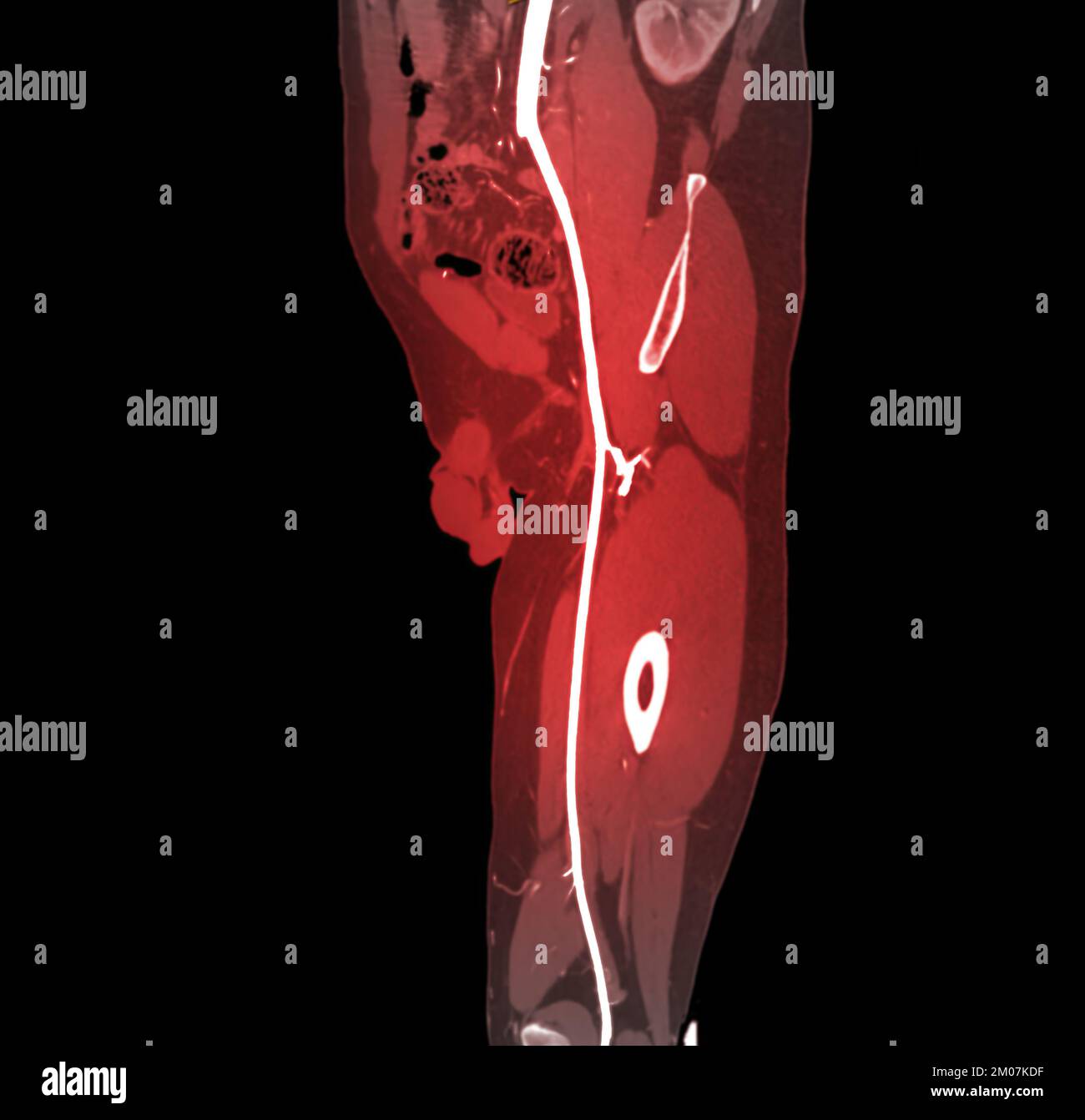 CTA femoral artery run off image of femoral artery for diagnostic Acute