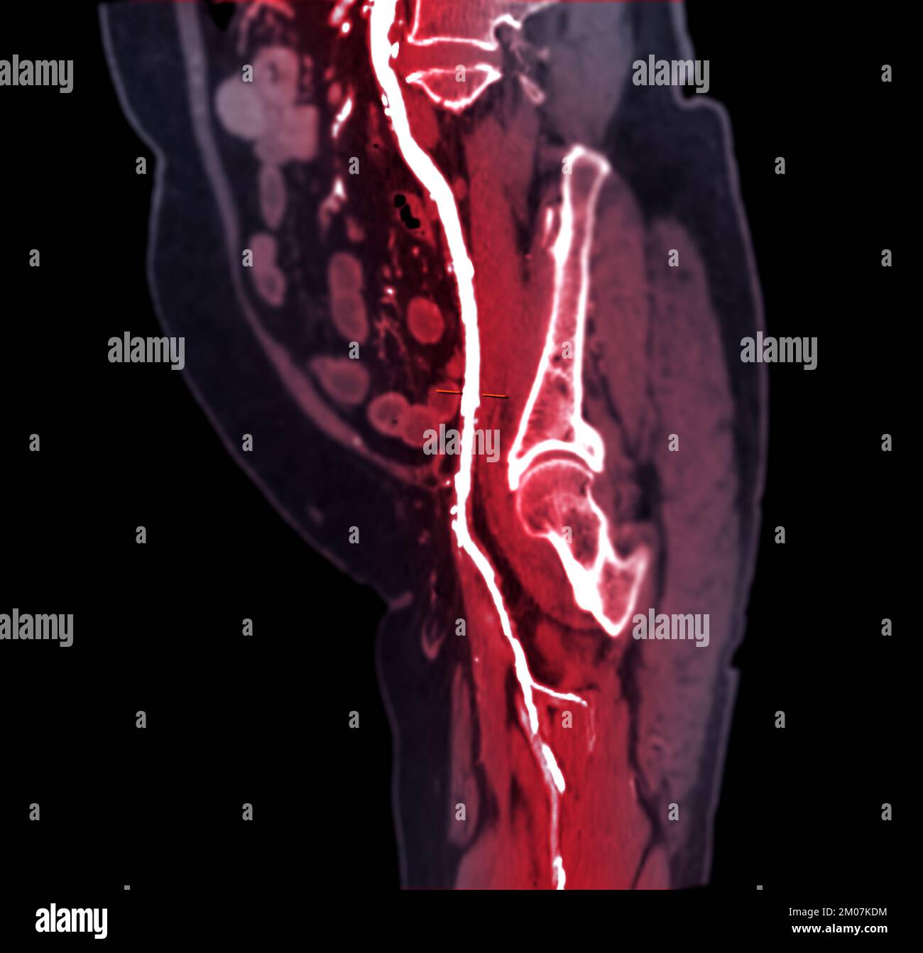 CTA femoral artery run off image of femoral artery for diagnostic Acute ...