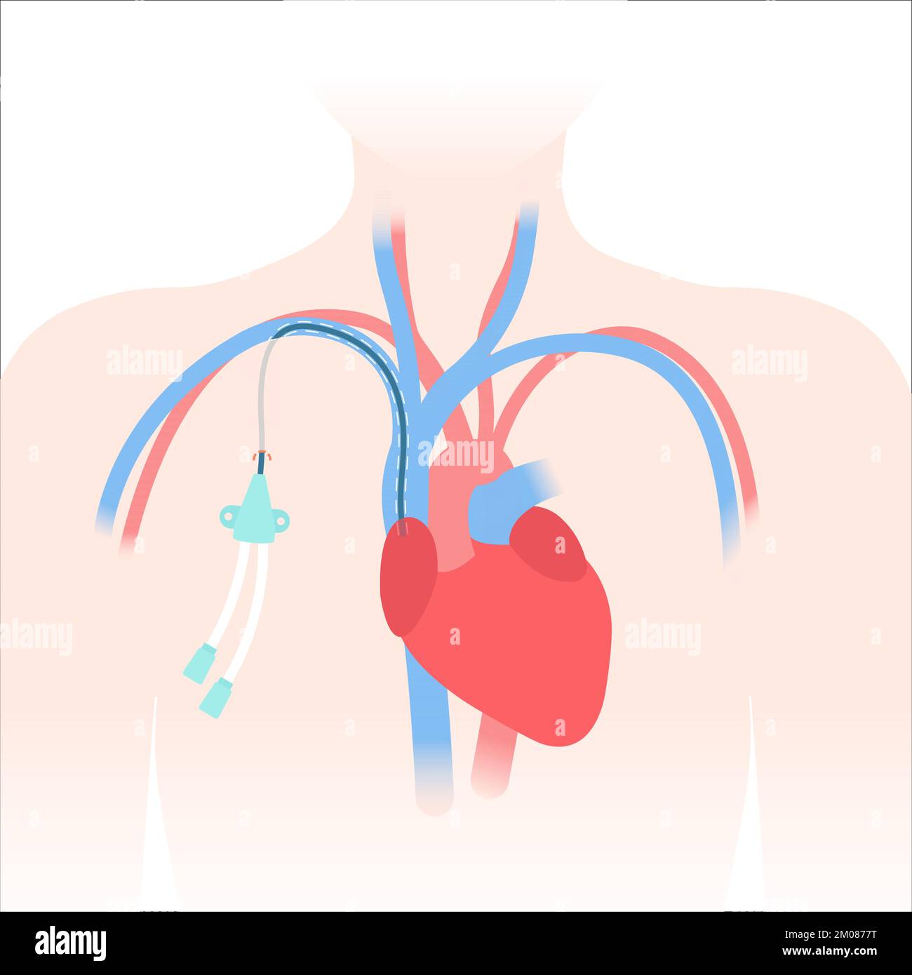 Tunneled central venous catheter placed in the subclavian vein. Patient