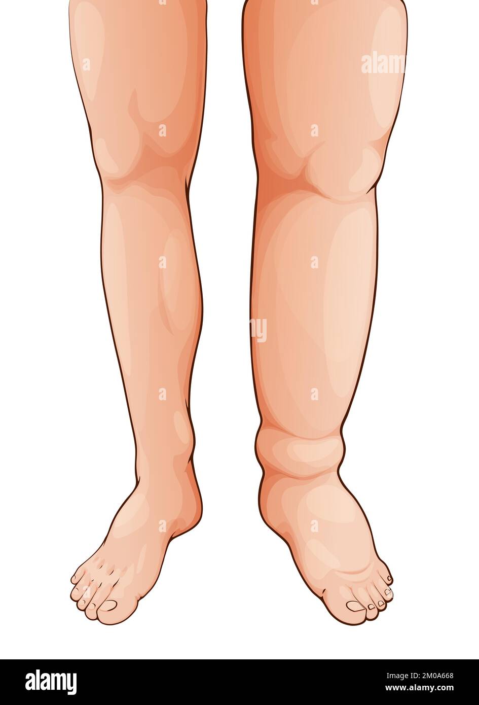 Edema swollen leg and foot. Lymphedema. Oedema disease symptom, fluid retention in legs, lymph