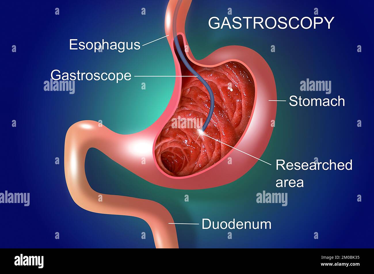 Digestive endoscopy or gastroscopy. Performing a gastroscopy procedure. Diagnostics of gastric diseases. Stomach health. Medical concept Stock Photo
