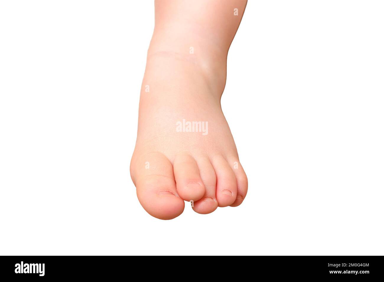 Deformed toes on the foot of the toddler baby, congenital curvature