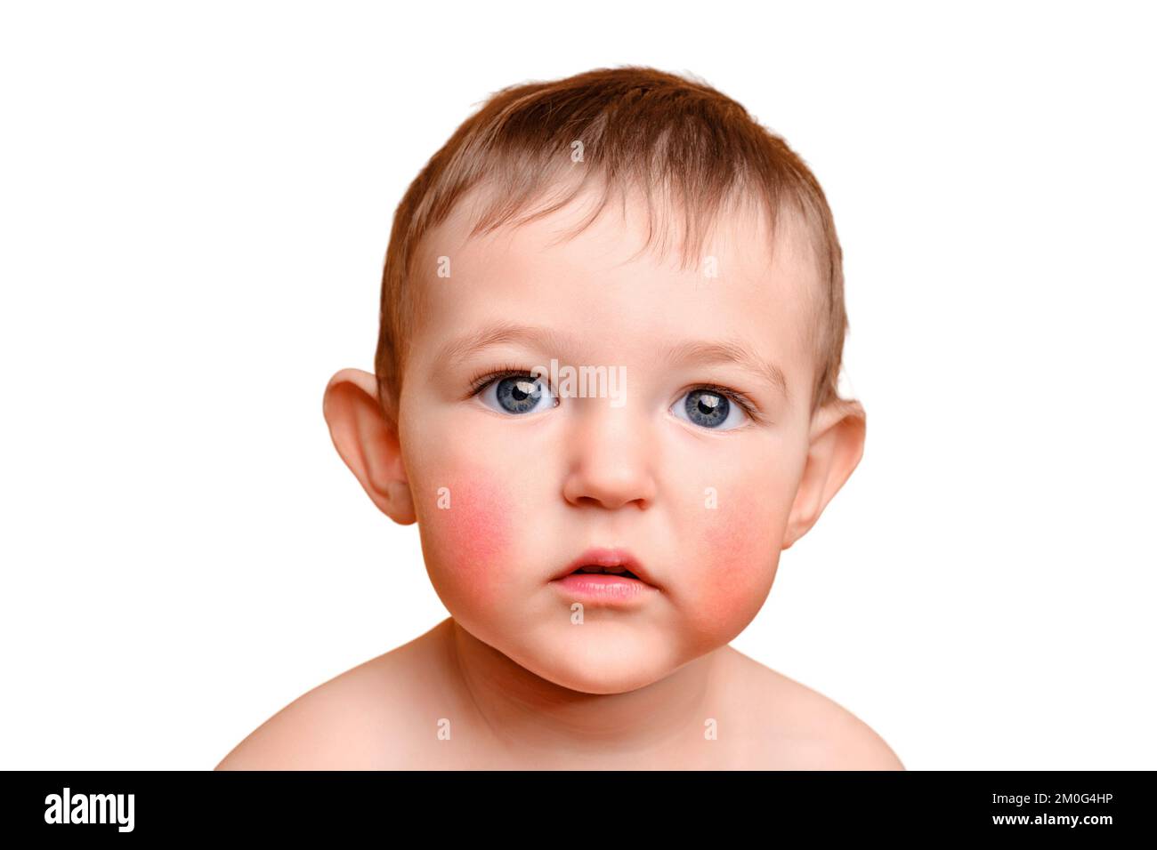 Sad toddler baby with allergies on her face, studio white background