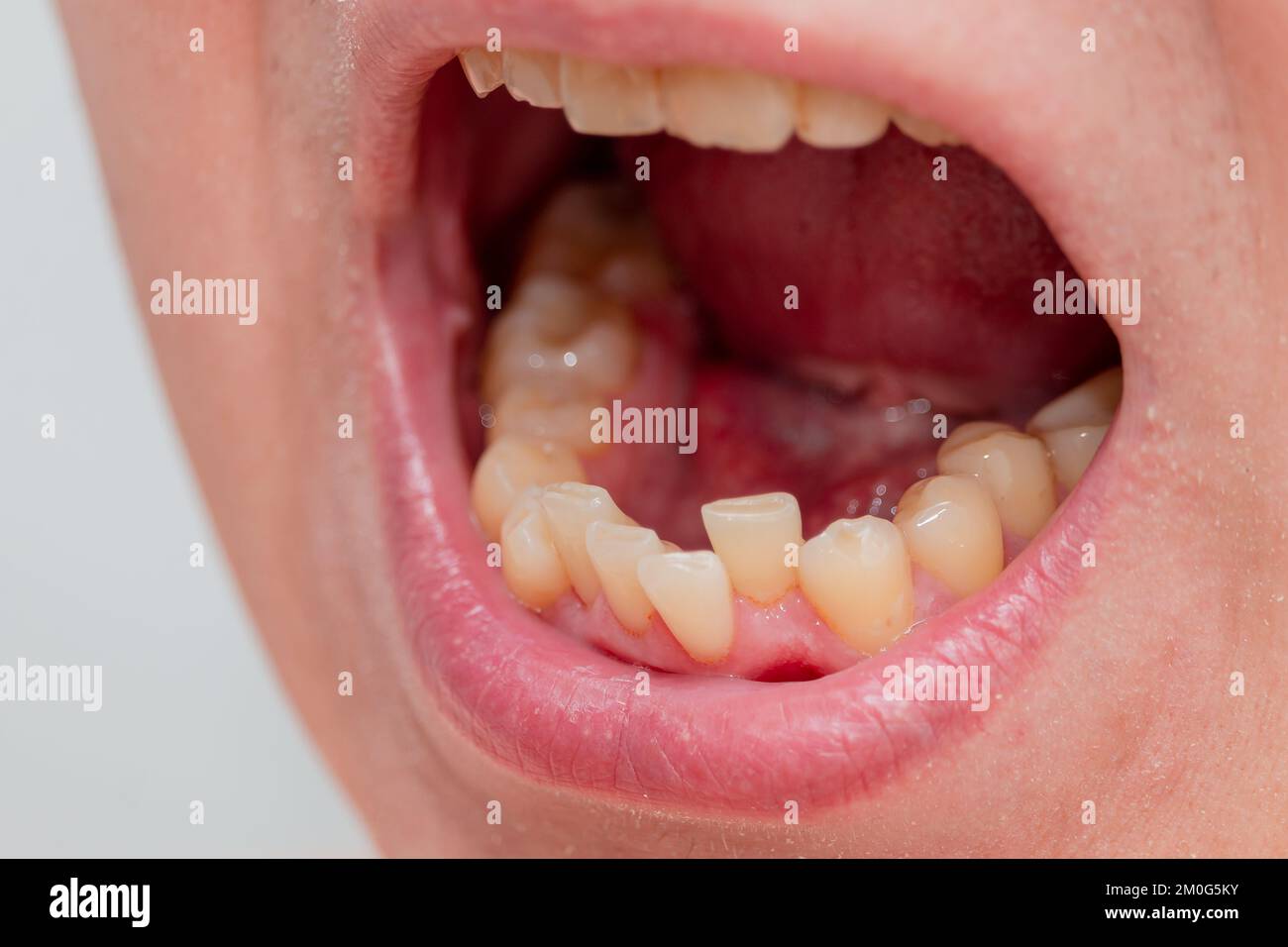 European male open mouth crooked yellow teeth dry lips Stock Photo Alamy