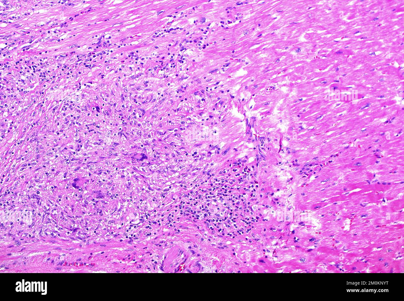 Heart sarcoidosis, light micrograph Stock Photo - Alamy