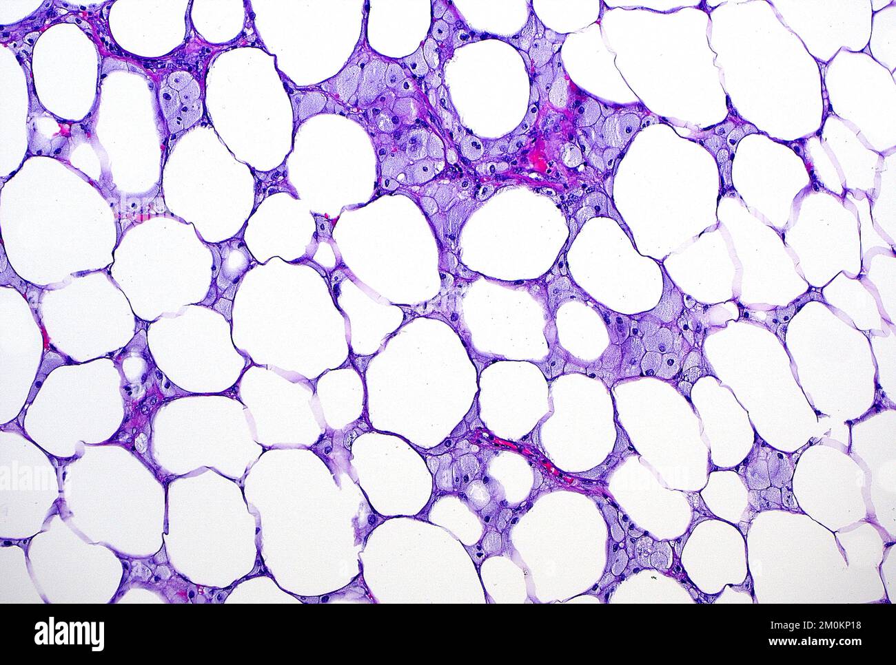 Fat necrosis, light micrograph Stock Photo Alamy