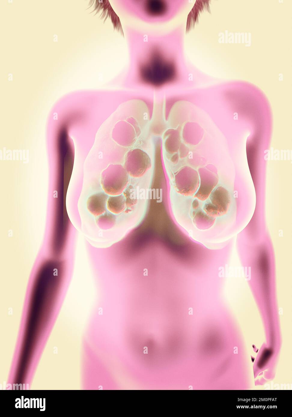 Human anatomy, problems with the respiratory system, severely damaged lungs. Bilateral pneumonia. Covid-19, coronavirus. Patient and smoke. Smoker. Stock Photo