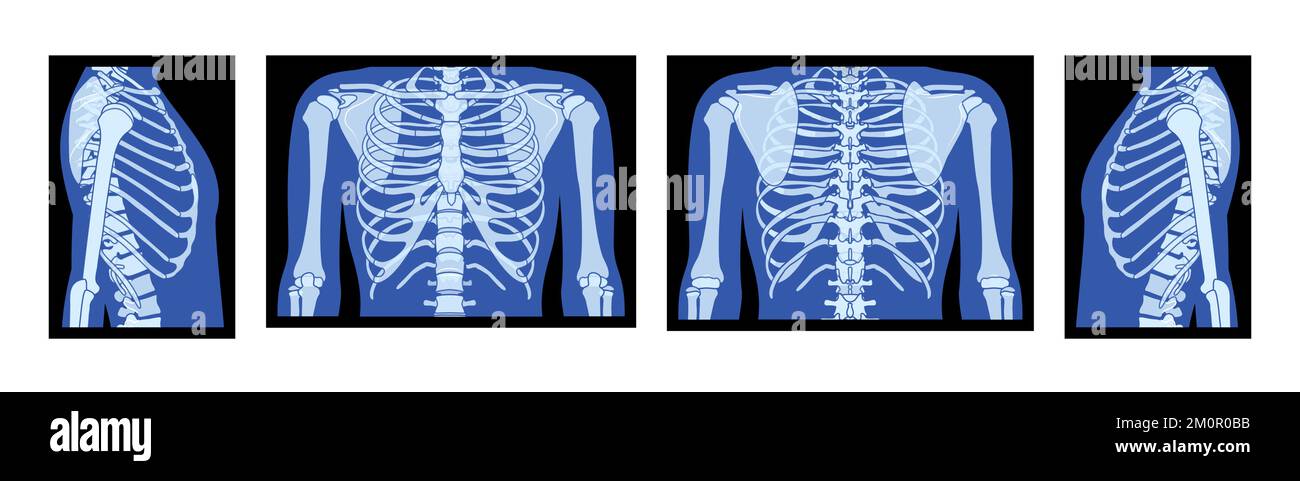 Set of X-Ray rib cage and hands Skeleton Human body Bones adult people roentgen front back side view. 3D realistic flat blue color Vector illustration of medical anatomy isolated on black background Stock Vector