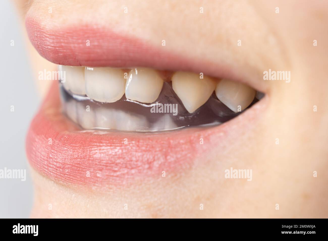 Dental mouthguard, splint in the mouth for the treatment of dysfunction