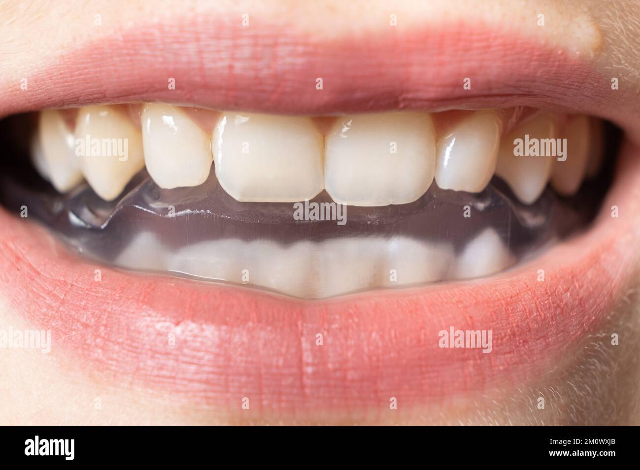 Dental mouthguard, splint in the mouth for the treatment of dysfunction