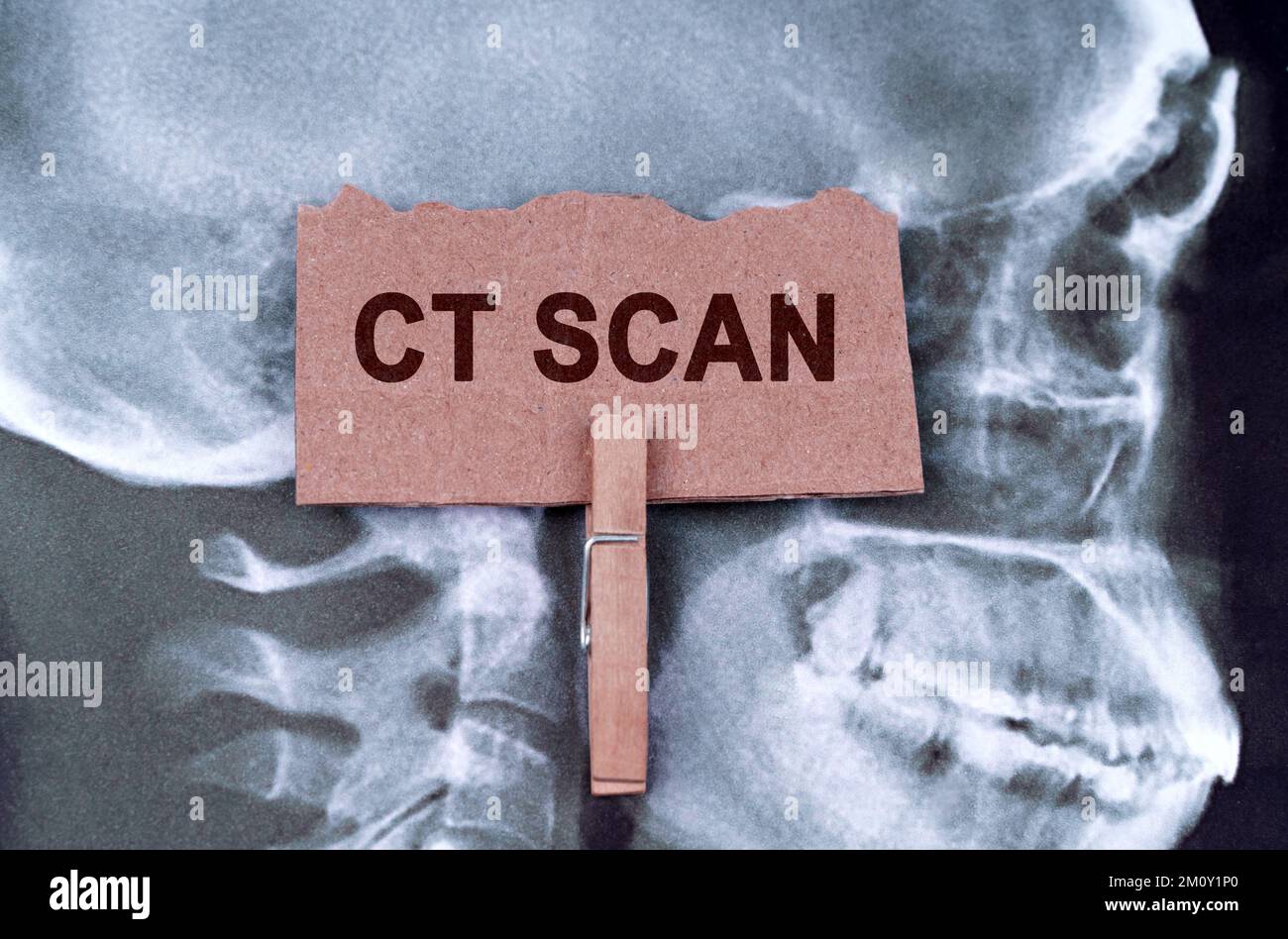 Medicine concept. Against the background of an X-ray of the skull, a plate with the inscription - CT scan Stock Photo
