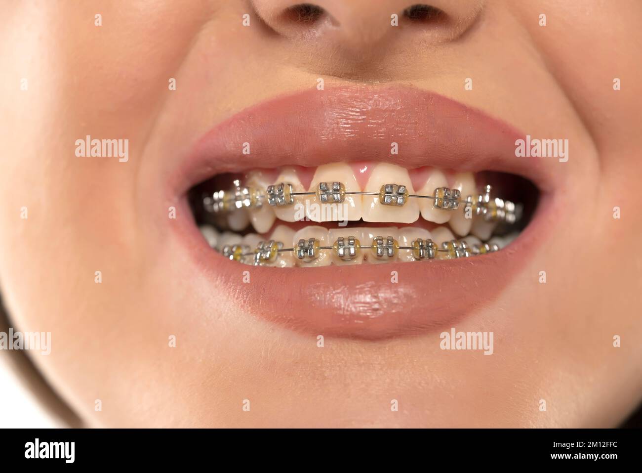 Beautiful macro shot of natural white teeth with braces. Dental care ...