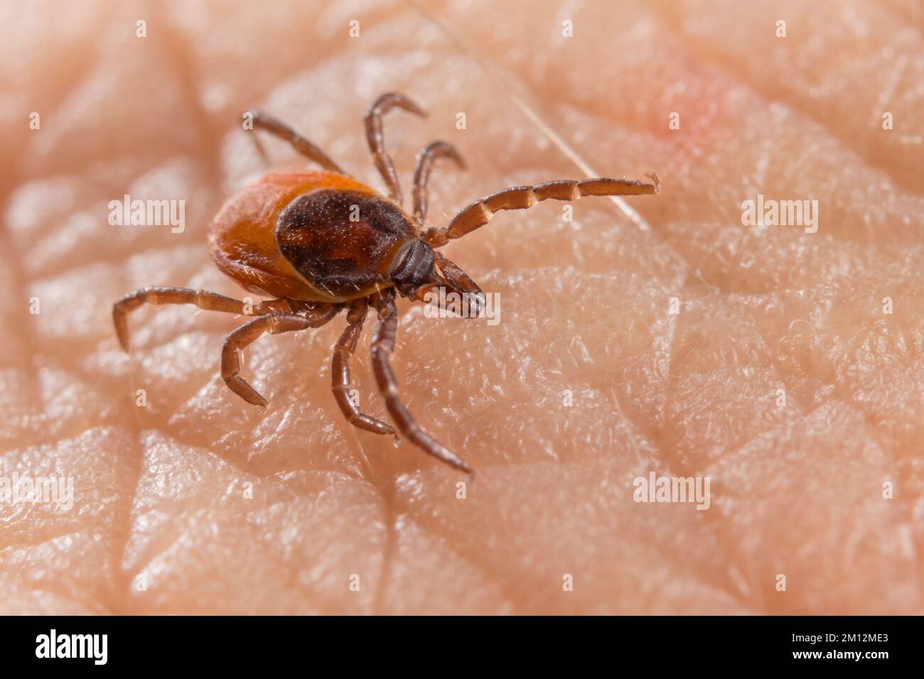 Close-up of deer tick on human skin detail in background. Ixodes ricinus or scapularis. Infectious diseases carrier. Encephalitis or Lyme borreliosis. Stock Photo
