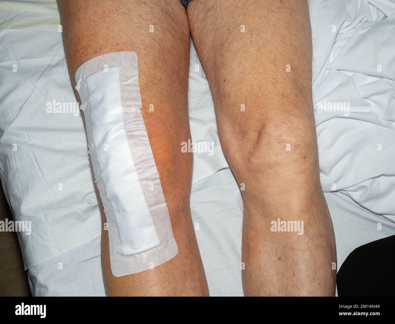 Knee joint replacement, elderly patient under doctor surgical medical