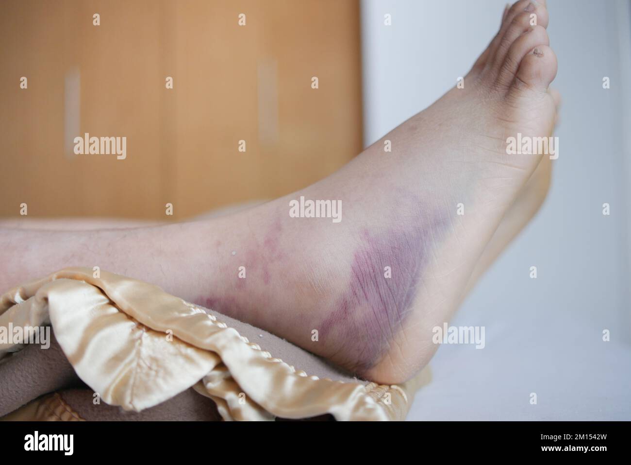 close up of women feet with swelling Stock Photo Alamy
