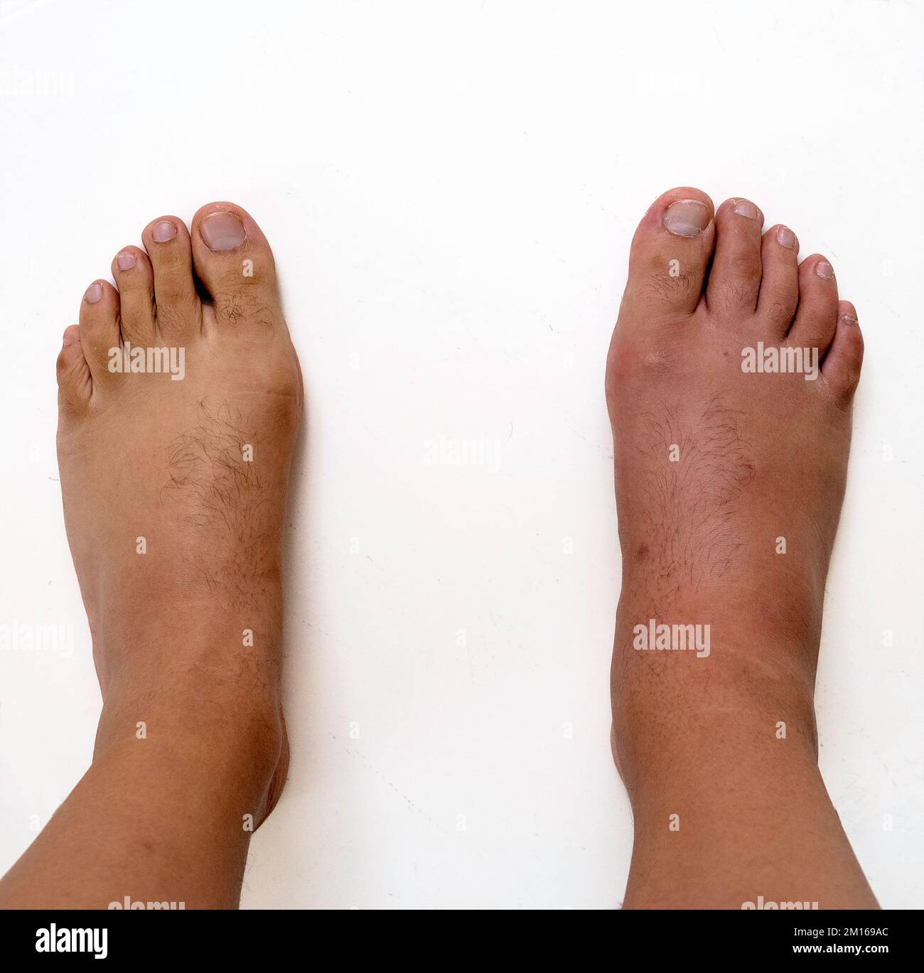 Feet comparison between a healthy foot and a foot going through a gout ...