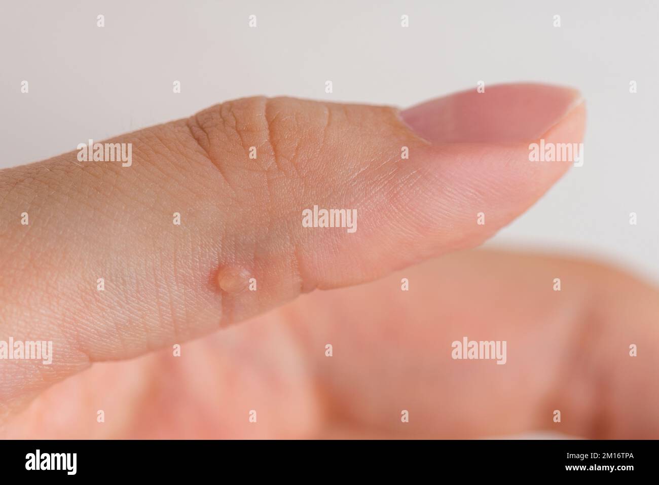 Wart on hand. The concept of treating warts and other skin defects. Close-up of a wart on a finger, a benign growth on human skin. Stock Photo