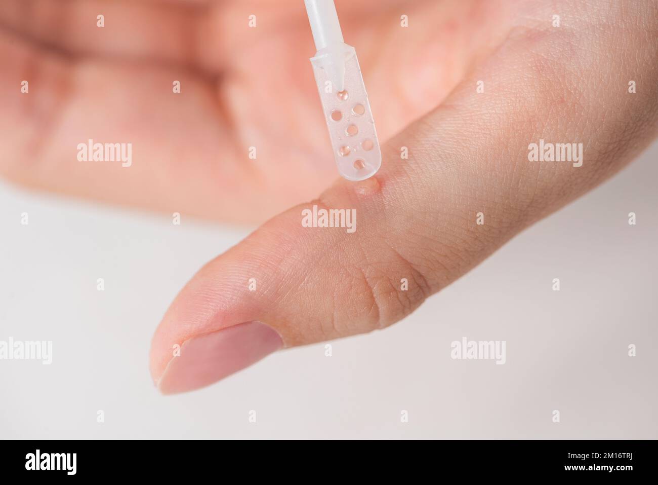 Wart treatment process. The doctor applies the medicine with a special