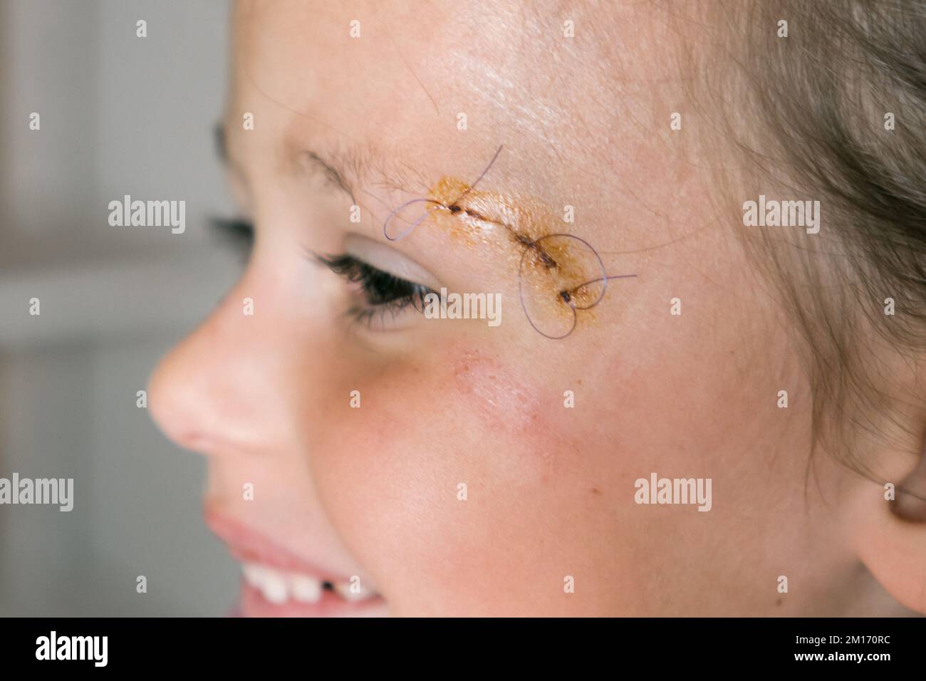 Close up smiling patient kid girl face with stitches, joints on scratch