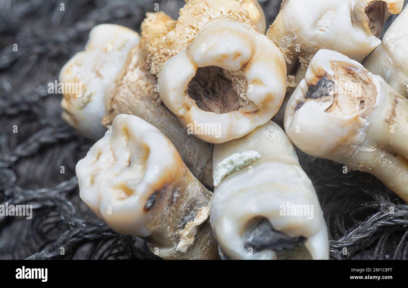 the bundle of unwanted extracted decay human teeth. Stock Photo