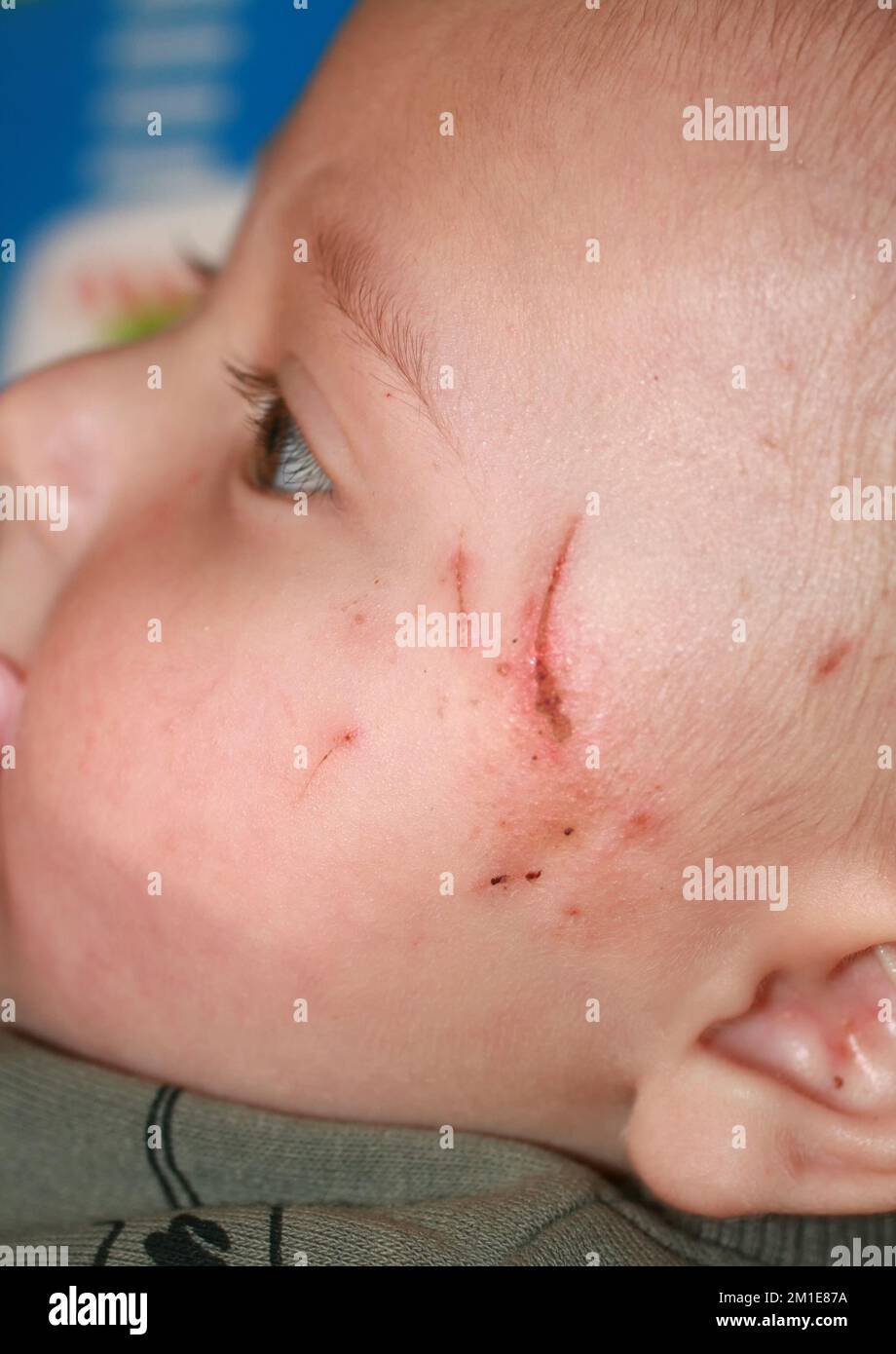 The child scratches his skin. Scratches on the baby's skin. The skin face is inflamed Stock