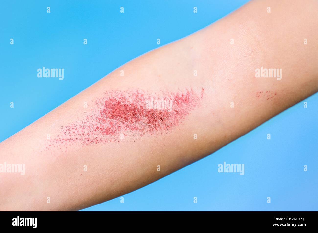 Children's hand burn. Children's hand with a burnt wound on a blu background.Close up Stock Photo