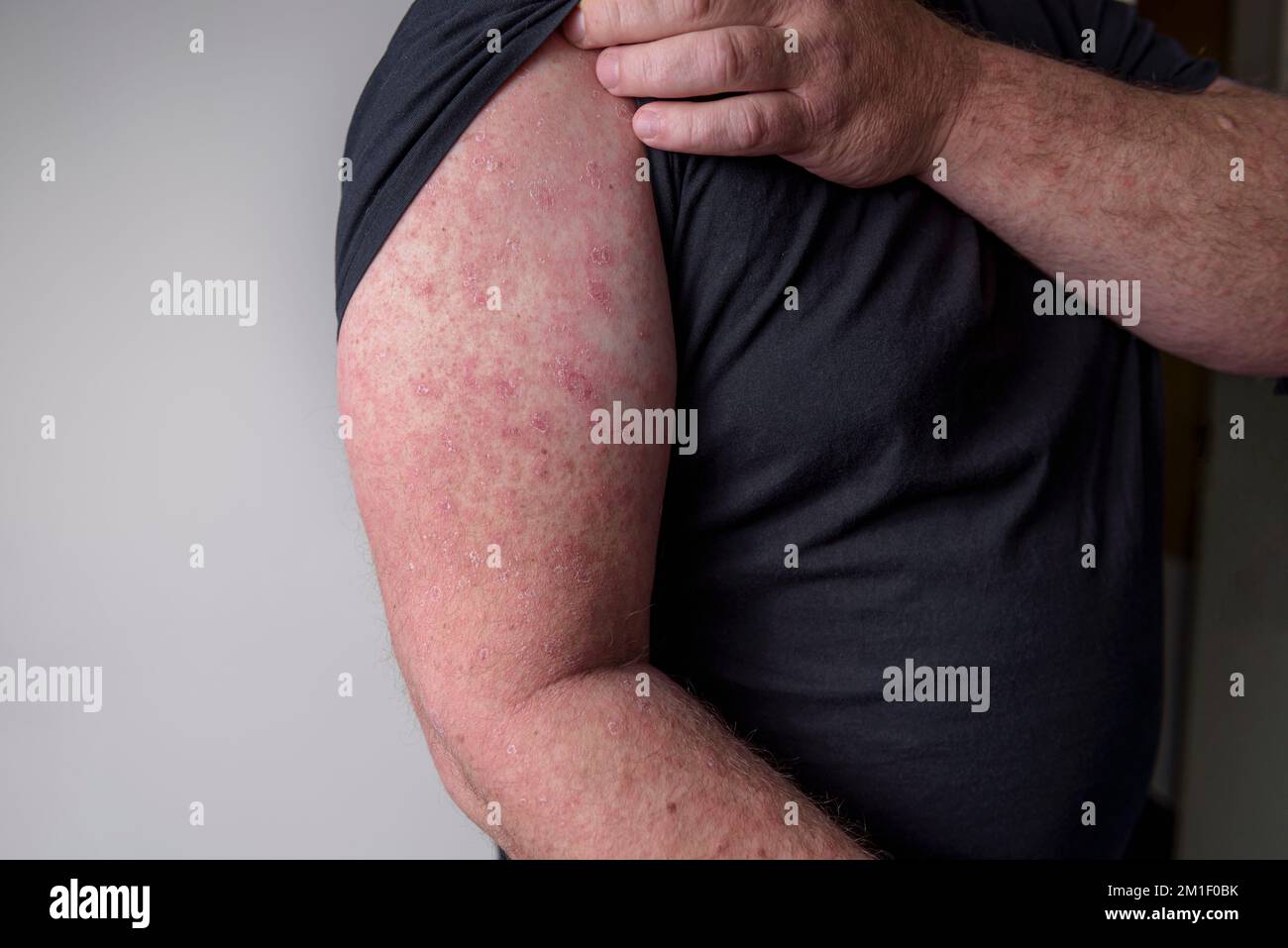 Erysipelas on the hand. Close up. A red rash appears on the forearm. Stock Photo