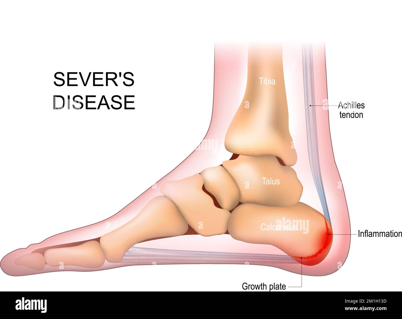Severs disease. calcaneus apophysitis. inflammation at the back of the heel growth plate. Foot anatomy. side view of a Human foot Stock Vector