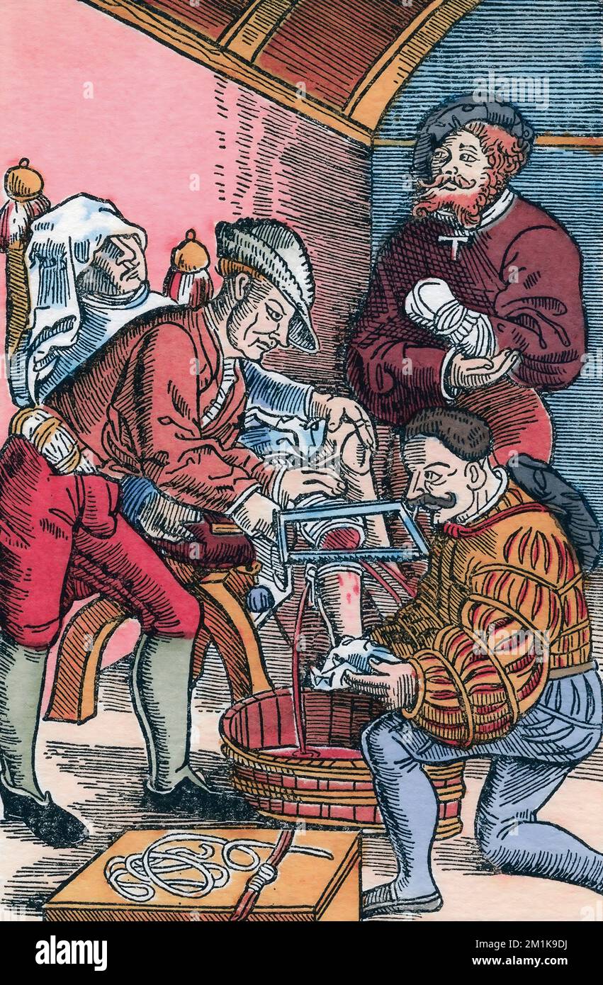 A patient has his leg amputated.  After an illustration by Hans von Gersdorff dating from the mid 16th century.  Later colorization.  Von Gersdorf, aka Schyl-Hans, was himself an accomplished surgeon in Strasbourg. Stock Photo