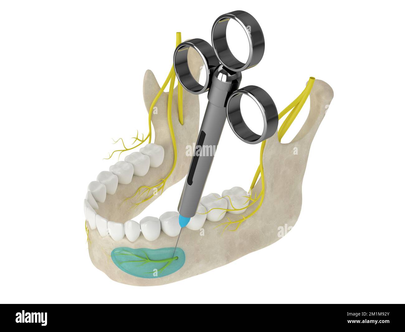 Mandibular arch with incisive nerve block. Types of dental anesthesia concept. Stock Photo