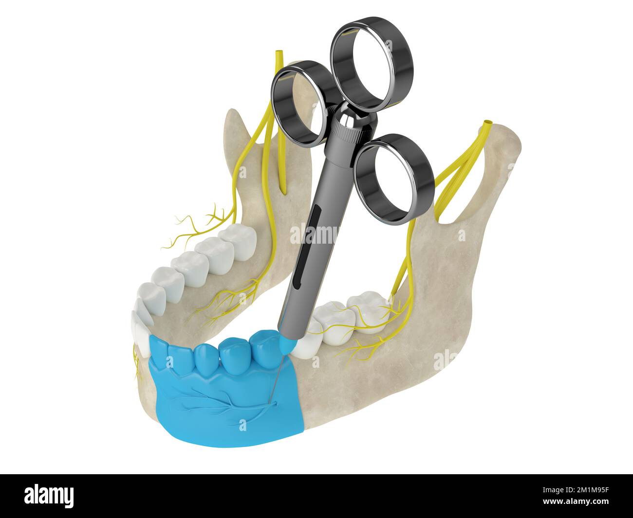 Mandibular arch with incisive nerve block. Types of dental anesthesia concept. Stock Photo