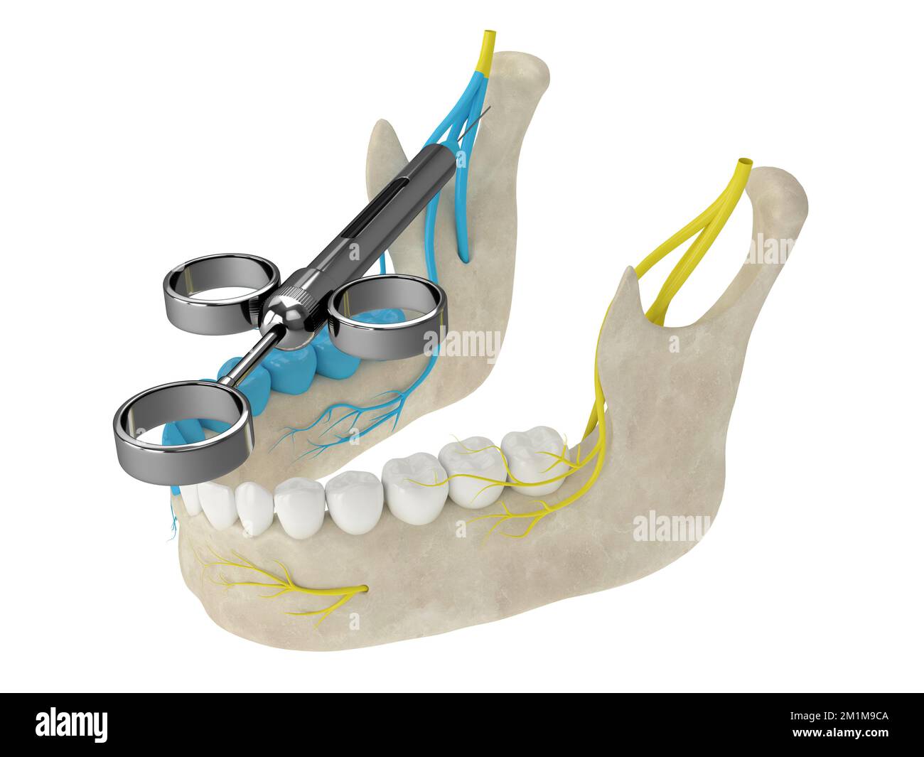 3d render of mandibular arch with gowgates nerve block. Types of