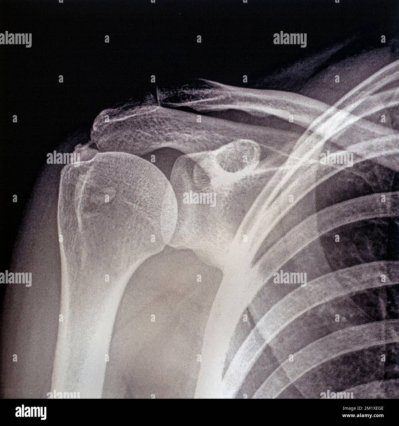 Internal Rotation Shoulder Xray