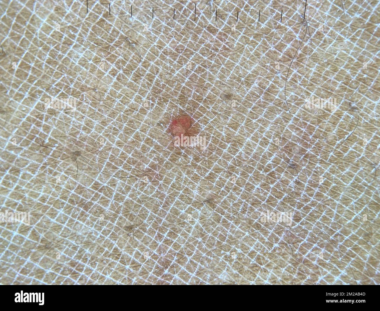 Cherry angioma, dermoscopy Stock Photo Alamy