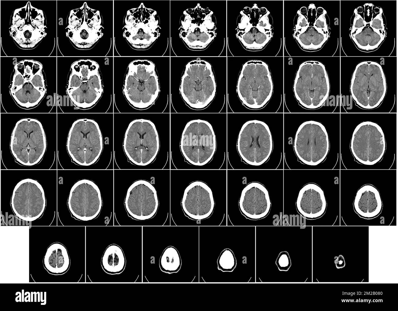 X-Ray of the brain | Radiographie du cerveau 03/11/2017 Stock Photo - Alamy