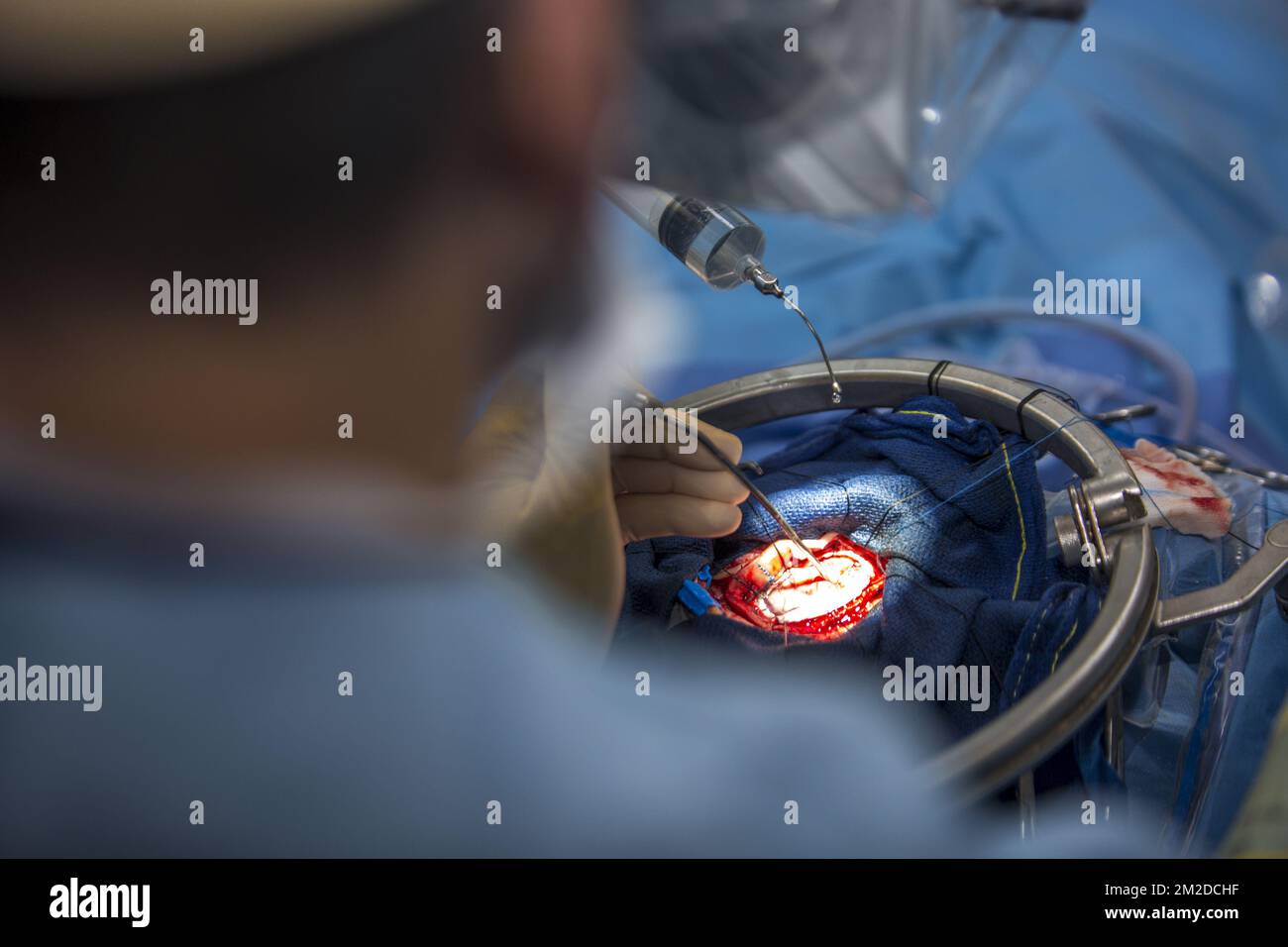Hersentumor hi-res stock photography and images - Alamy