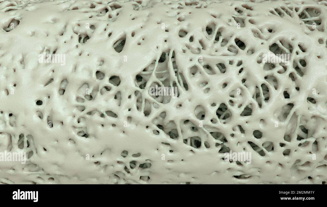 Cross section of an advanced osteoporosis - 3d rendering Stock Photo ...