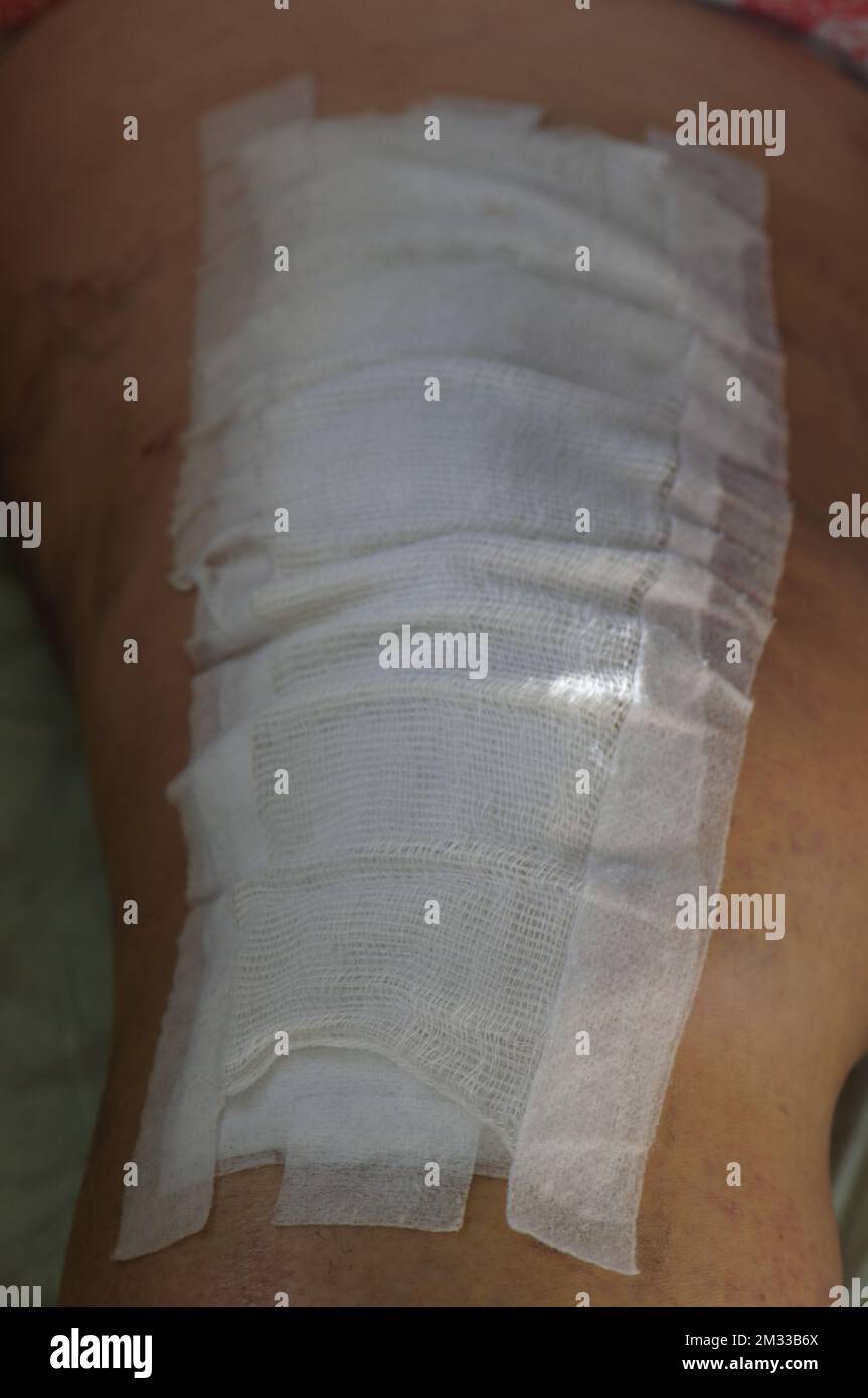 The surgical suture is covered with a gauze dressing. Total knee joint replacement. Close-up. Stock Photo