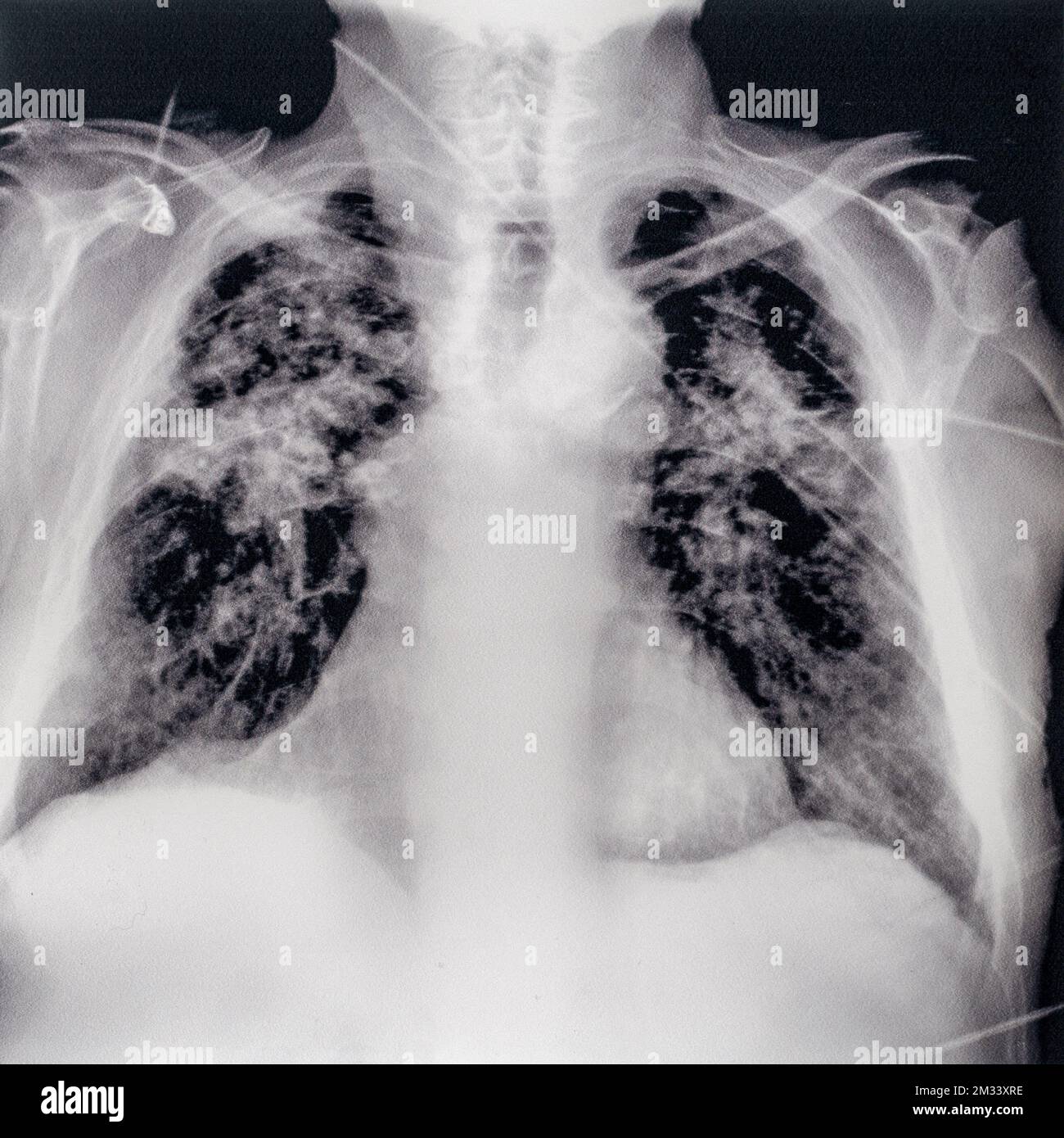 Old mid 20th century X-ray photograph / radiograph showing miner's lung / silicosis, lung disease caused by inhalation of crystalline silica dust Stock Photo