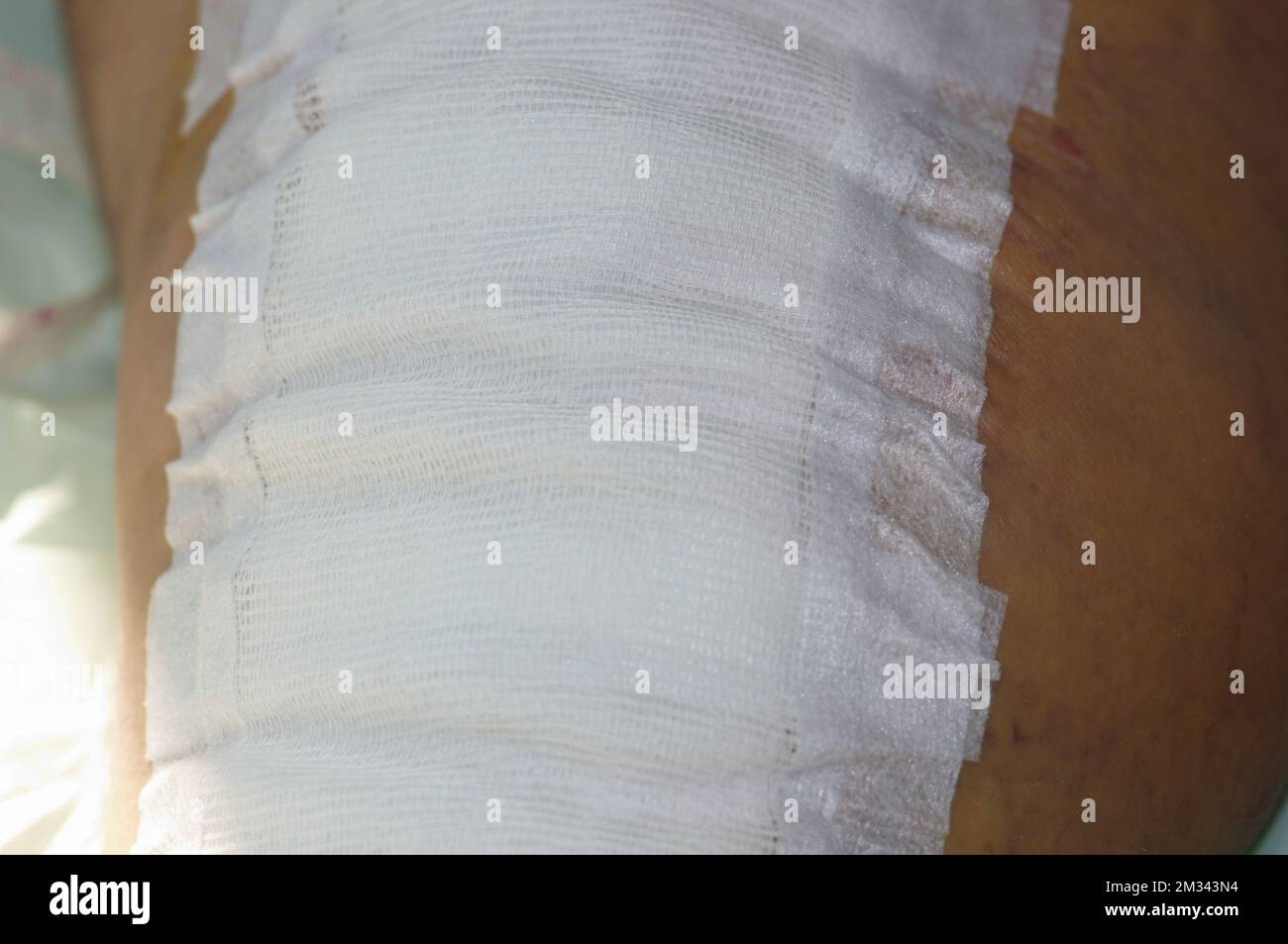 The surgical suture is covered with a gauze dressing. Total knee joint