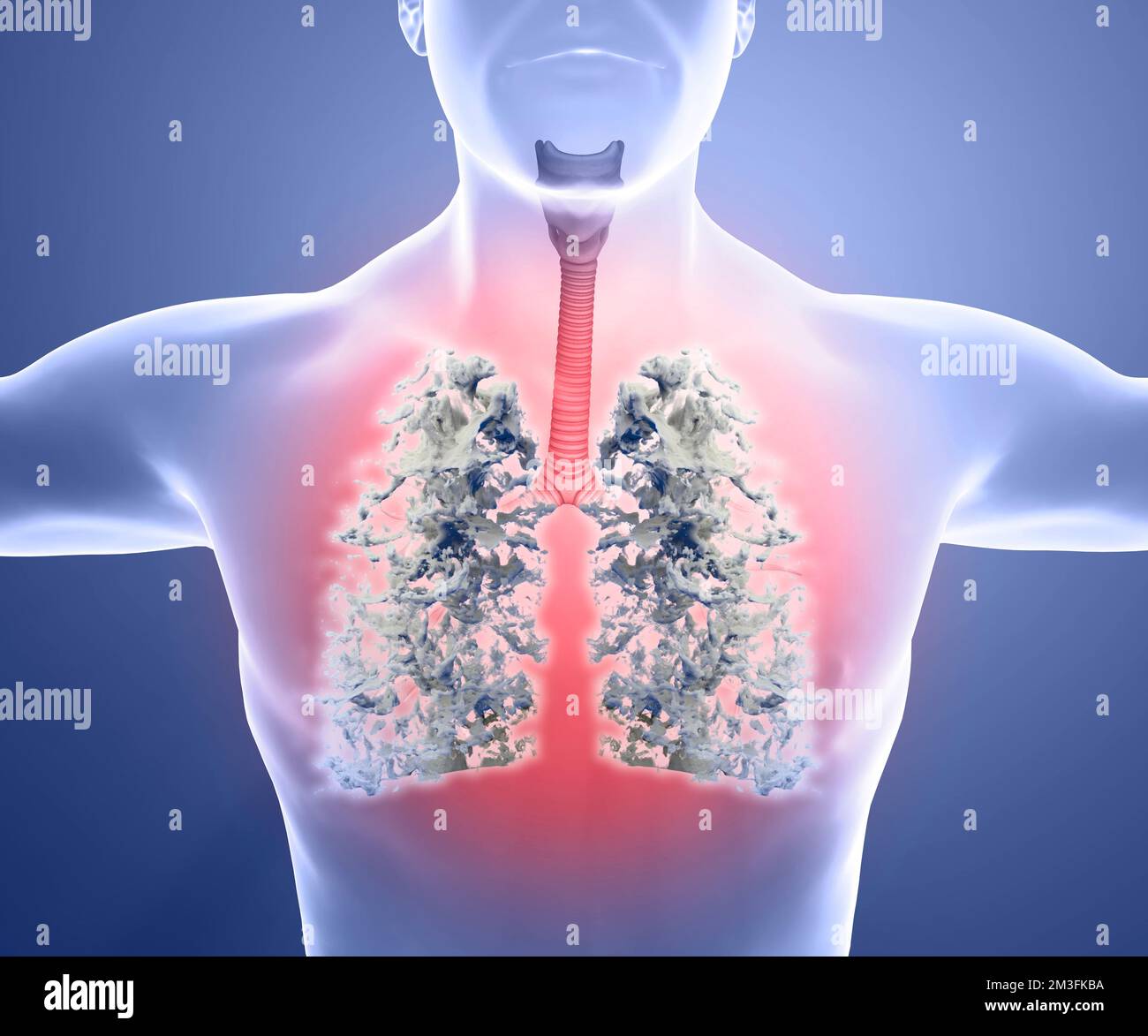 Human anatomy, problems with the respiratory system, severely damaged lungs. Bilateral pneumonia. Covid-19, coronavirus. Patient and smoke. Smoker. 3d Stock Photo