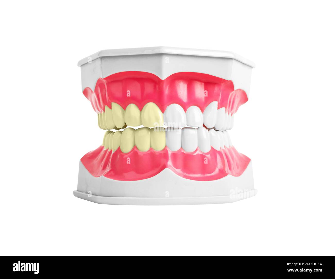 Tooth jaw before and after whitening concept. Healthy vs unhealthy, bad