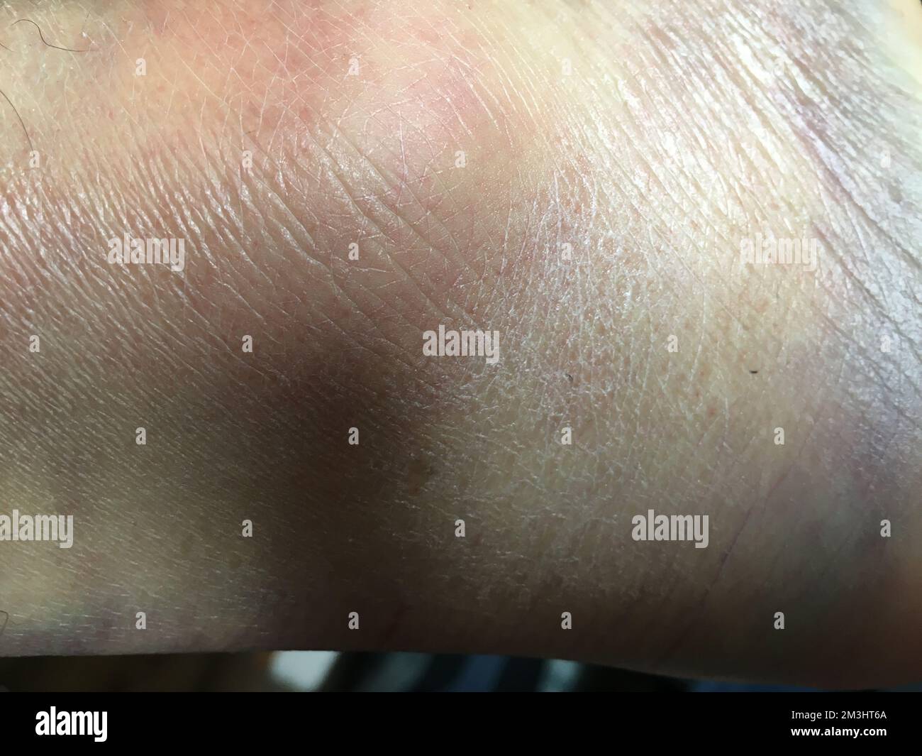 Sprained Skin Coloured bruises, sprained, dislocated ankle. Abstract shades, skin ...