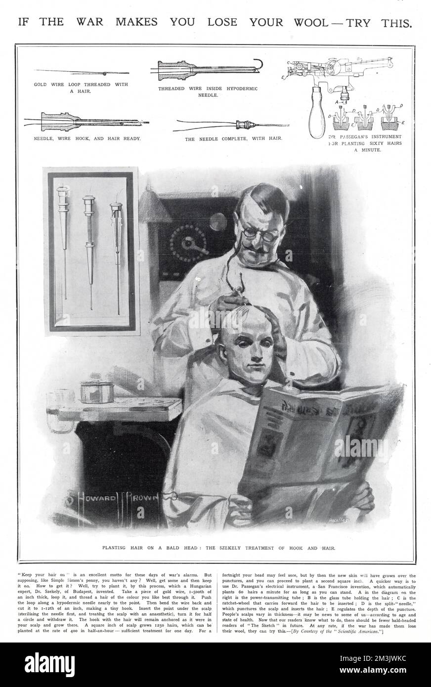 Entitled, 'If the War Makes you Lose Your Wool - Try This', this illustration shows an early form of hair transplanting, championed by a Dr. Szekely of Budapest. The technique, which threaded a wire with hair, which was then injected into the scalp through a hypodermic needle, could apparently plant as many as sixty hairs a minute in the patient's head, without, according to the picture, discomfort. Stock Photo