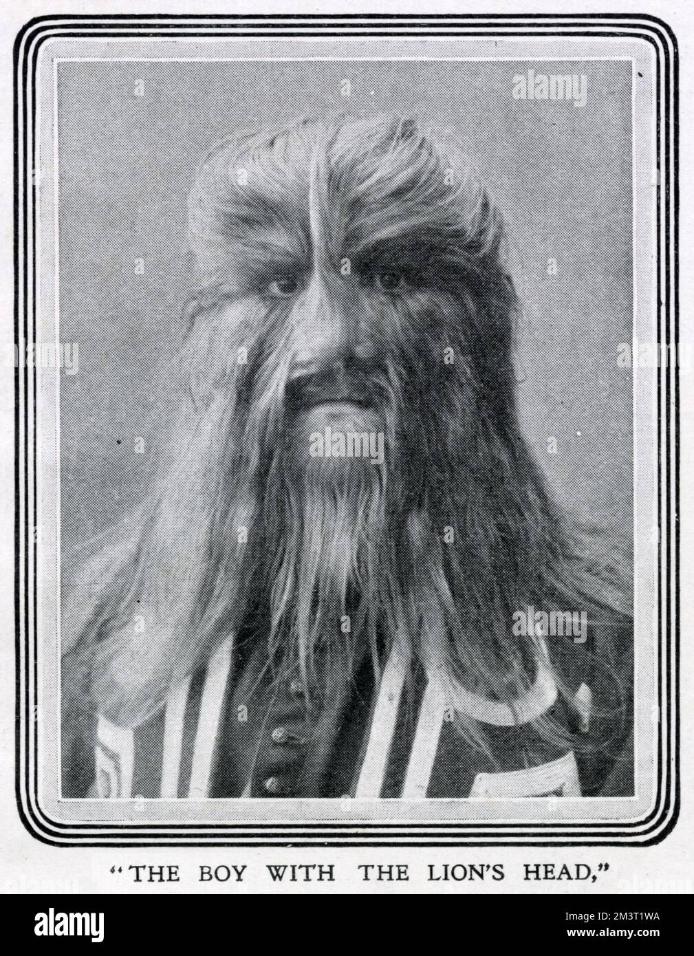 Stephan Bibrowski (1890 - 1932), know as 'Lionel the Lion-faced Man.' Lionel traveled to the United States and started appearing with the Barnum and Bailey Circus. He toured with the circus from then on, occasionally going back to Europe. Stock Photo